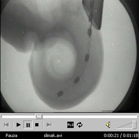 Kliknij aby obejrze� prezentacj� o umieszczaniu elektrod wewn�trz �limaka [5,75MB]